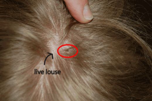What Does Head Lice Look Like
